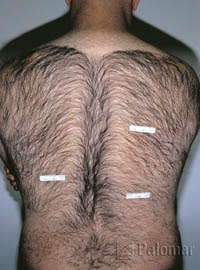 superhairy-back