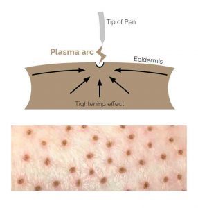 ACCOR Plasma Pen Skin Tightening Treatment Process Image